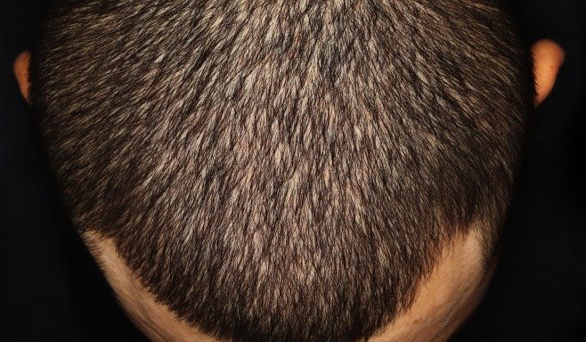 imageye___-_imgi_3_scalp-after_sotyktu