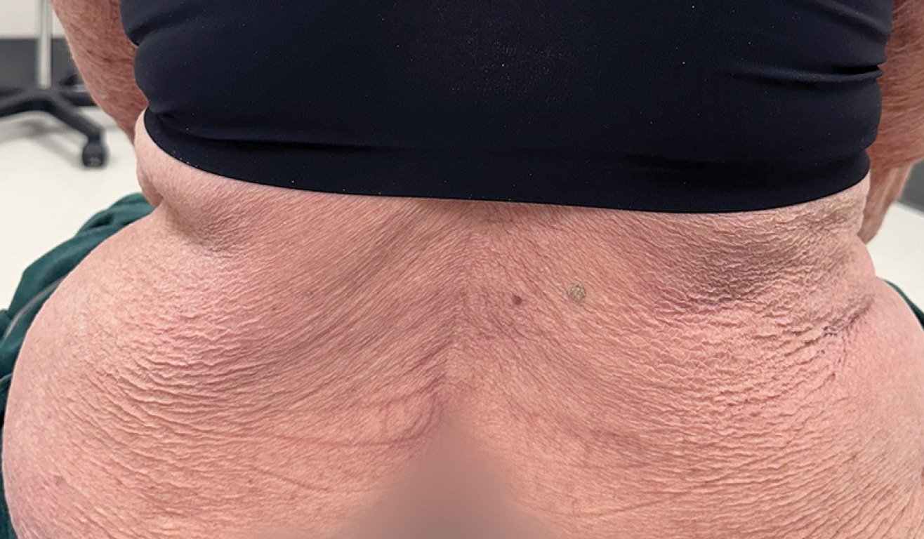 imageye___-_imgi_9_back-after_sotyktu